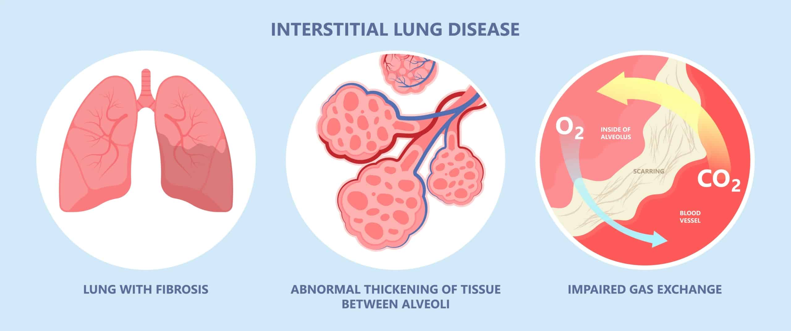 ABCs of ILD Whiteboard Animation - CME Outfitters Medical Education