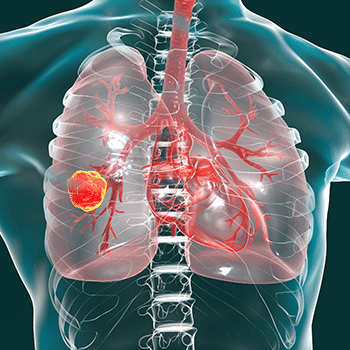 The Role of Antibody Drug Conjugates in Advanced Non-Small Cell Lung ...