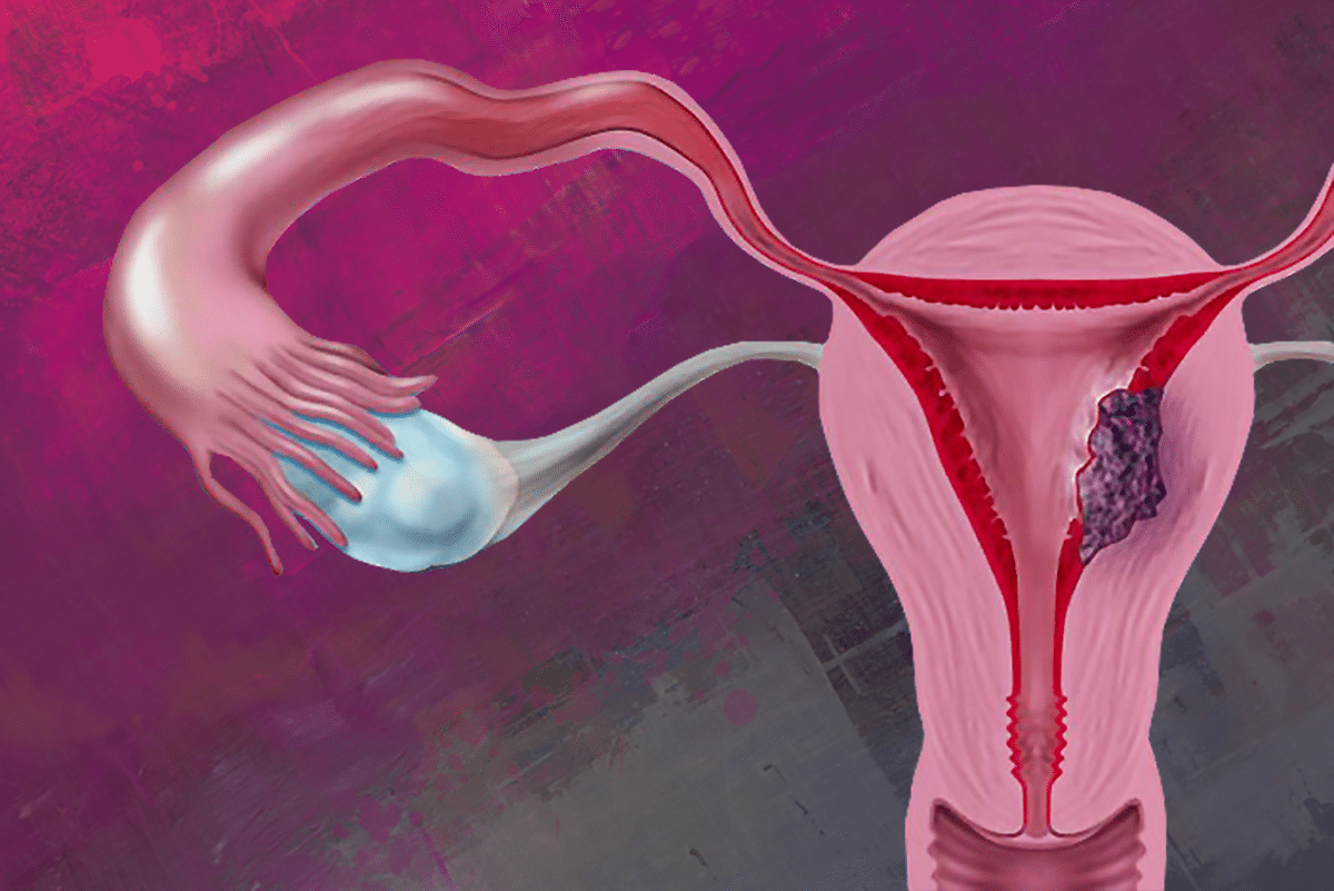 Actionable Opportunities for Molecularly Classified Endometrial Cancers ...